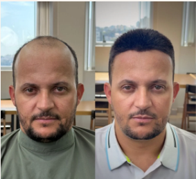 Antes e depois de prótese capilar