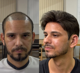 Antes e depois de prótese capilar